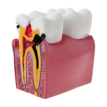 6-кратно сравнение на кариес Анатомическая модел на зъбите за стоматологична лаборатория по анатомия, инструмент за преподаване, обучение и научни изследвания